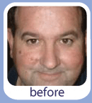 Moles, Warts & Skin Tags Removal