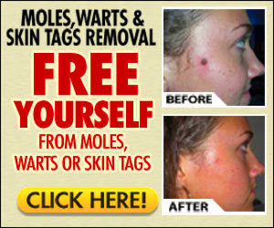 Moles, Warts & Skin Tags Removal