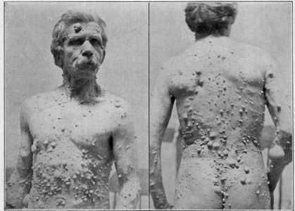 Fibroma is a rare condition in which skin tags can grow to a colossal size