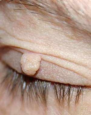 Skin tag on upper eyelid
