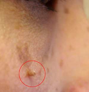 Skin tag on face
