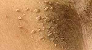 skin tag cluster in the arm pit